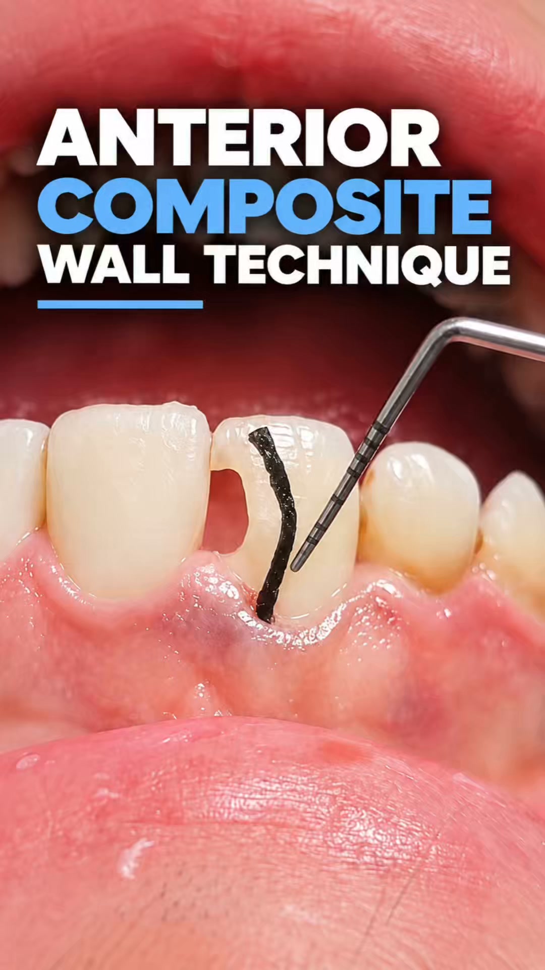 End Open Contacts on Anterior Composites