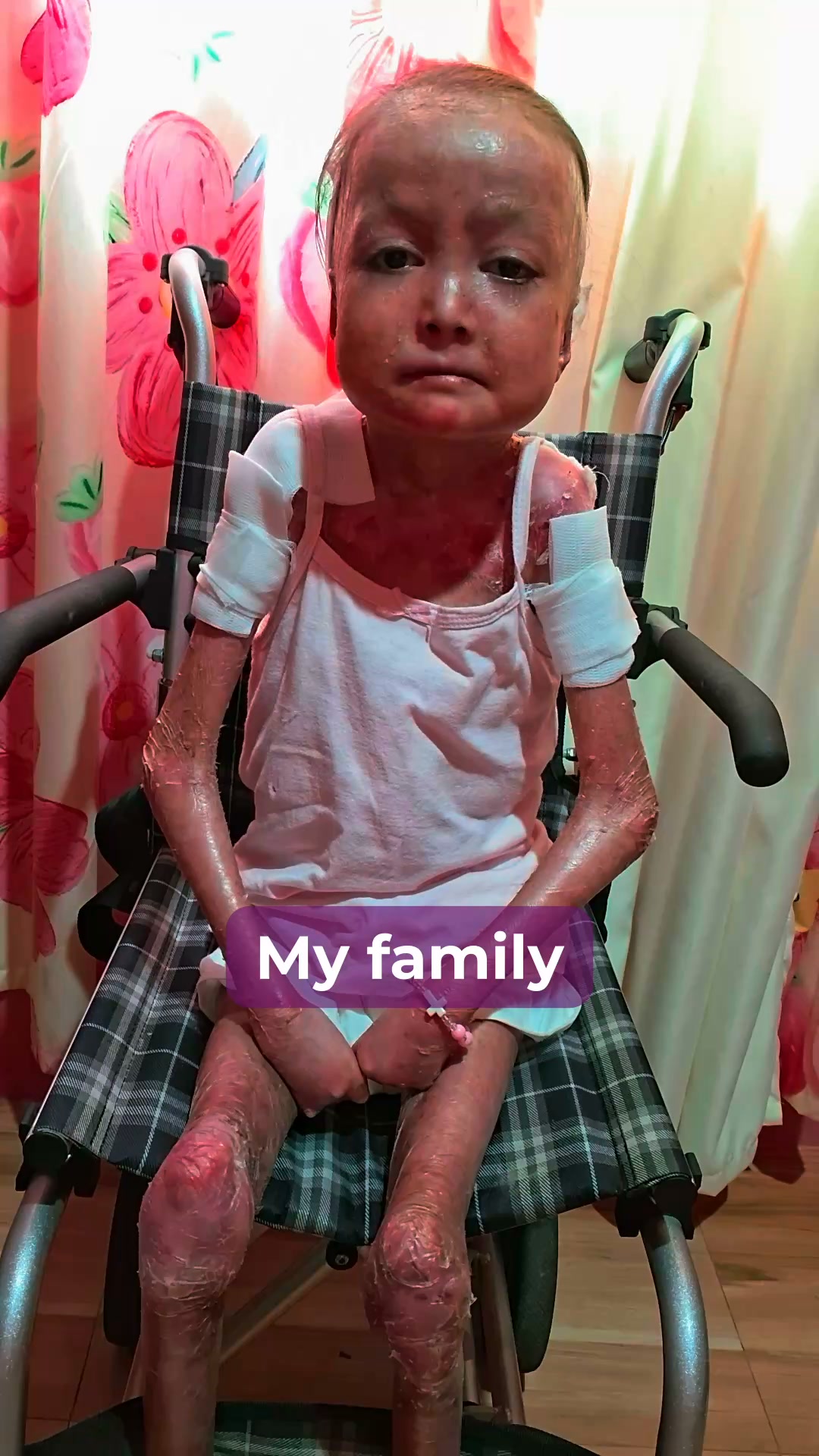 Shamila’s Skin Is Falling Off. Help Her.