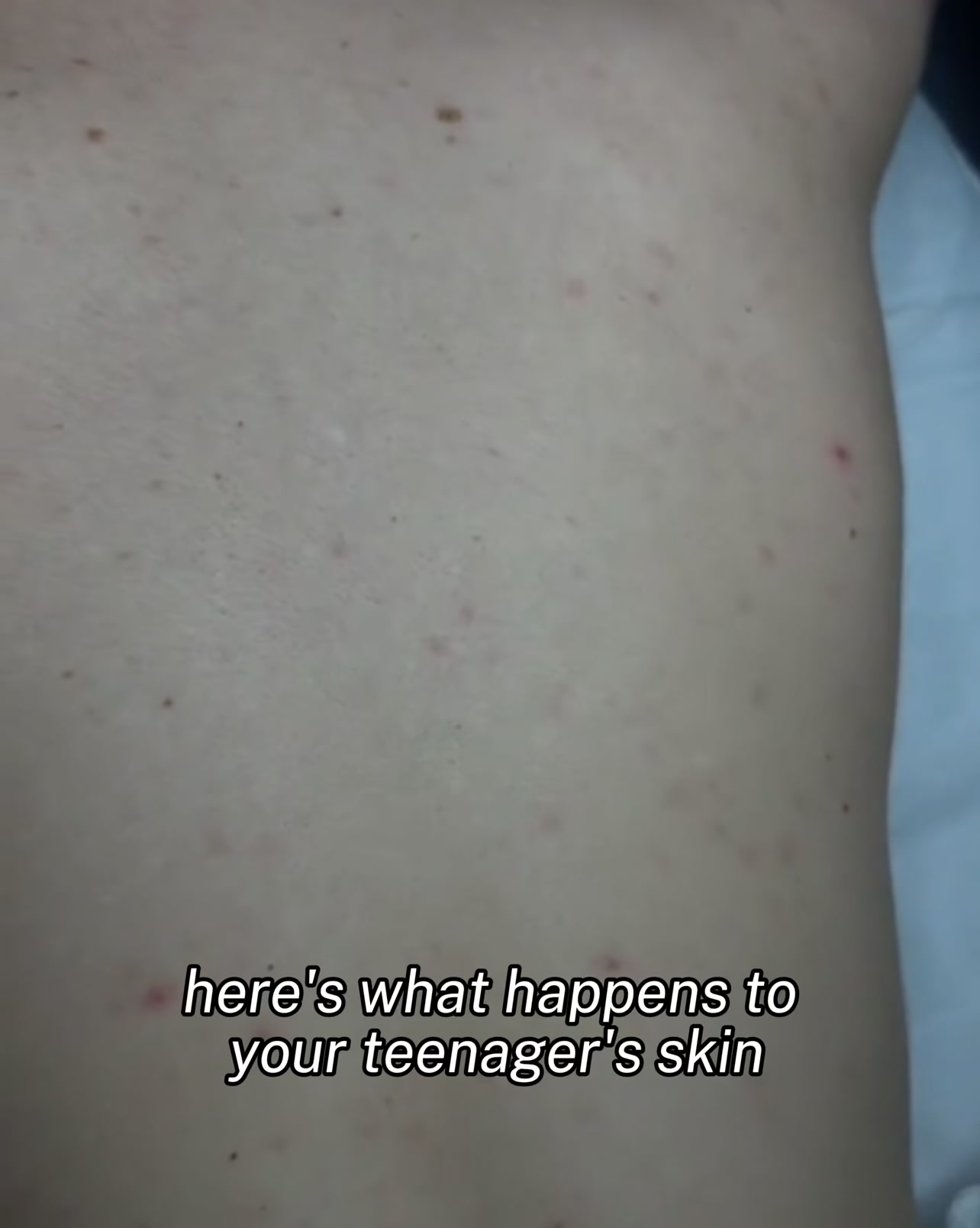 Get rid of spots!