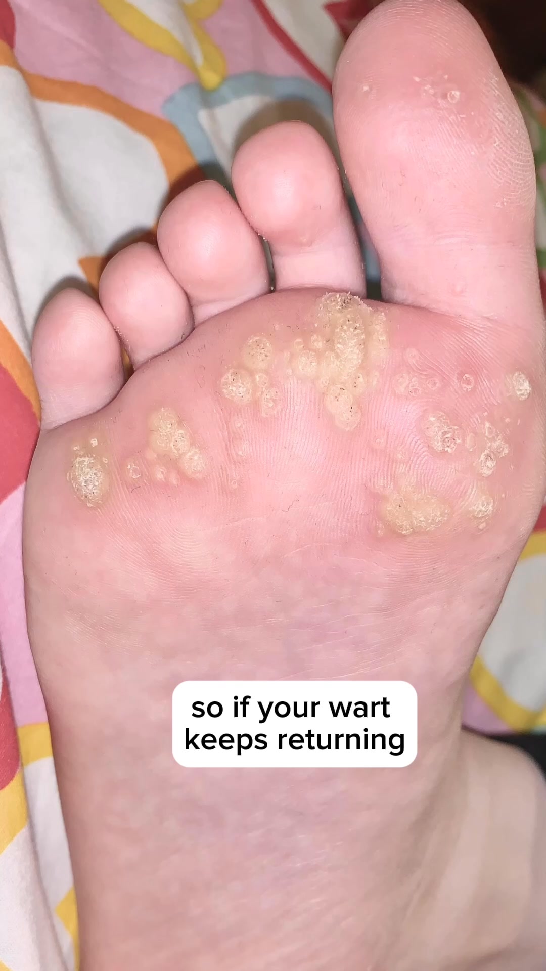 A Solution For Warts That Works