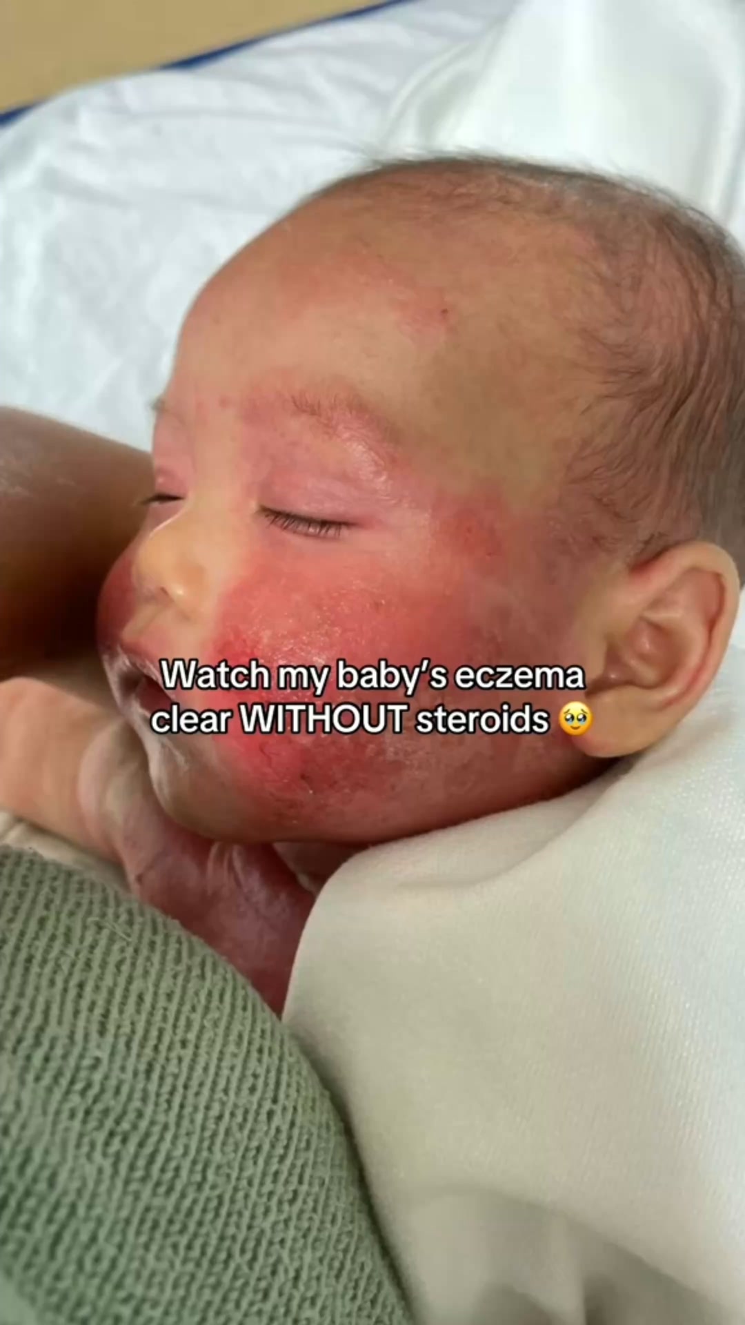 Clear Your Baby's Eczema in 30 Days — Or Your Money Back.