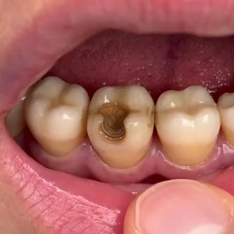 Restore Your Smile With Natural Enamel Repair Technology