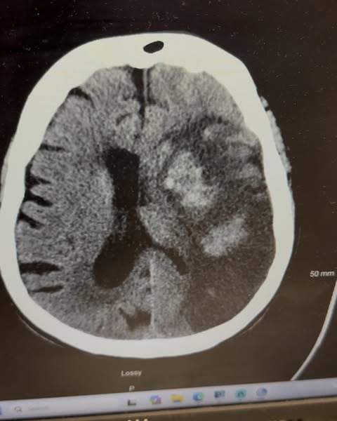 Why Most Stroke Survivors Stop Getting Better