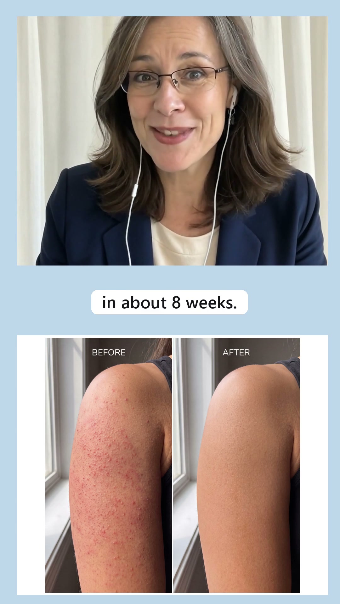 Your derm was wrong about "just genetic."