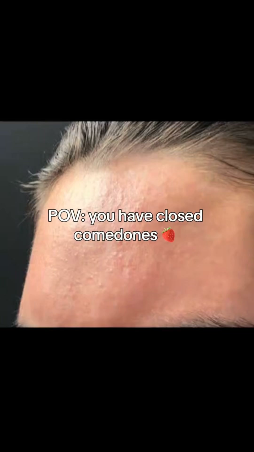 The Korean Answer To Acne’s Aftermath