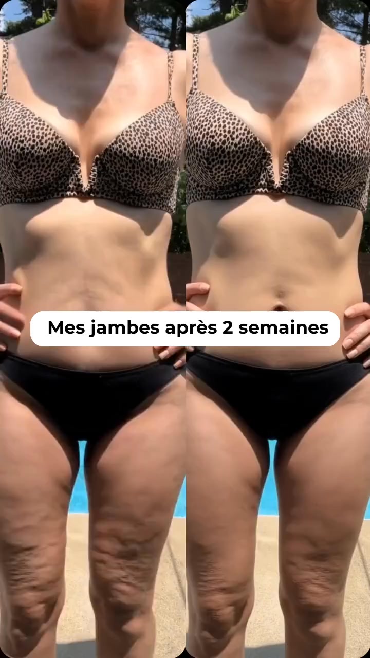 Éliminez la cellulite sans effort !
