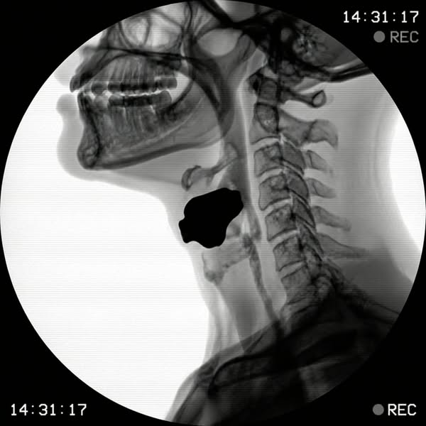 Eleven years of normal thyroid results and she was still exhausted. Read why