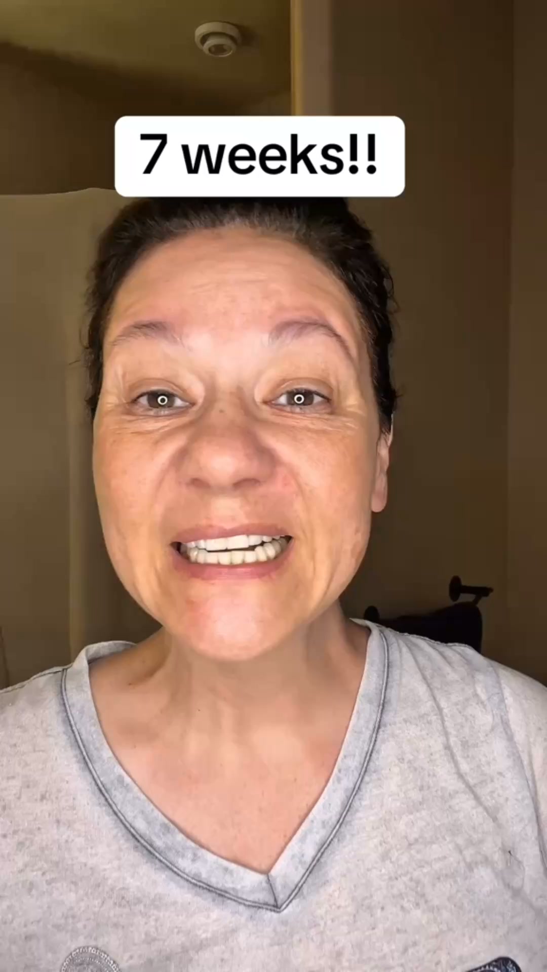 The Smarter Way to Remove Hormonal Hair