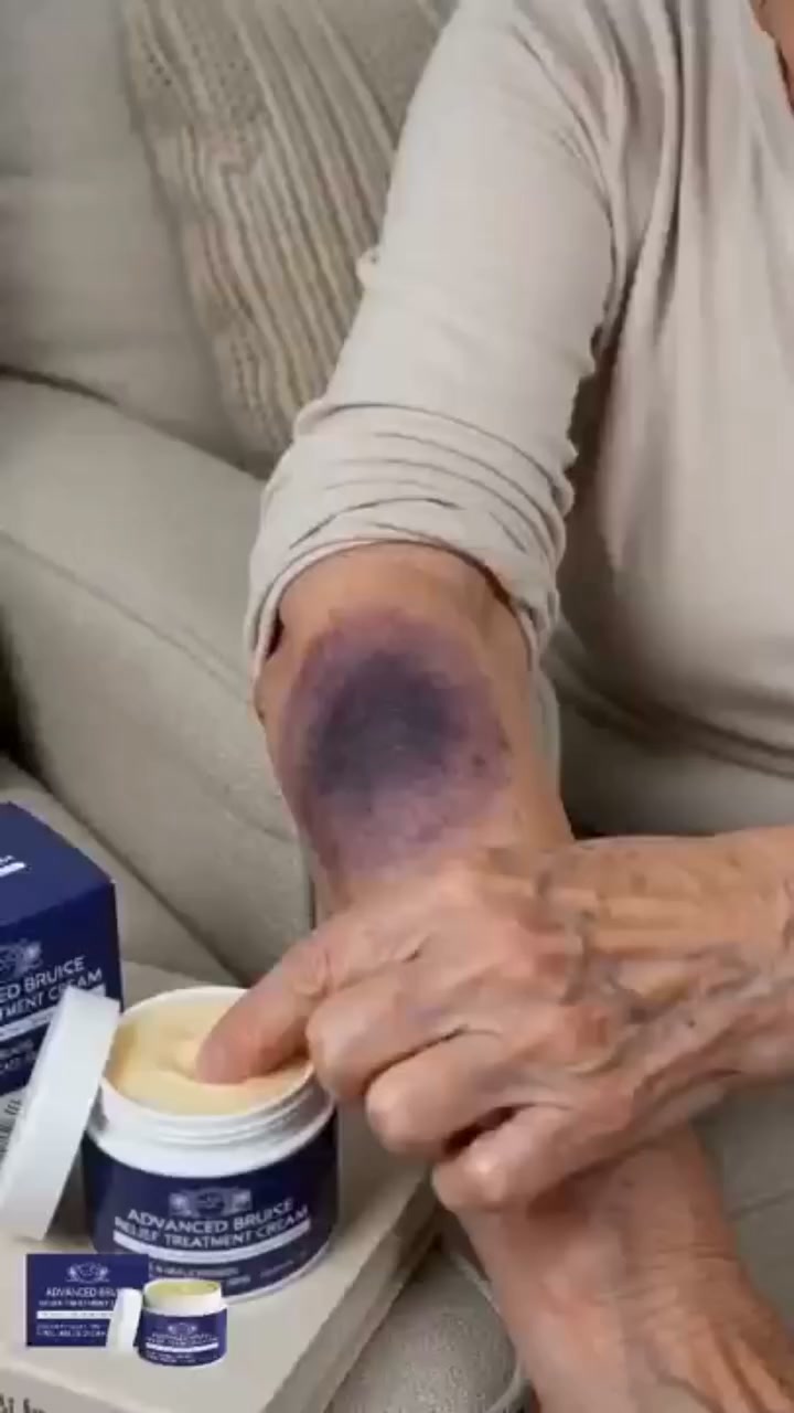 Say Goodbye to Unexplained Bruises