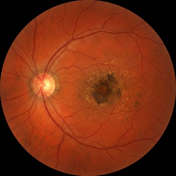 Read This If You Have Macular Degeneration