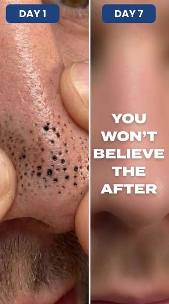 THE #1 PORE REMOVER MEN ARE SWITCHING TO