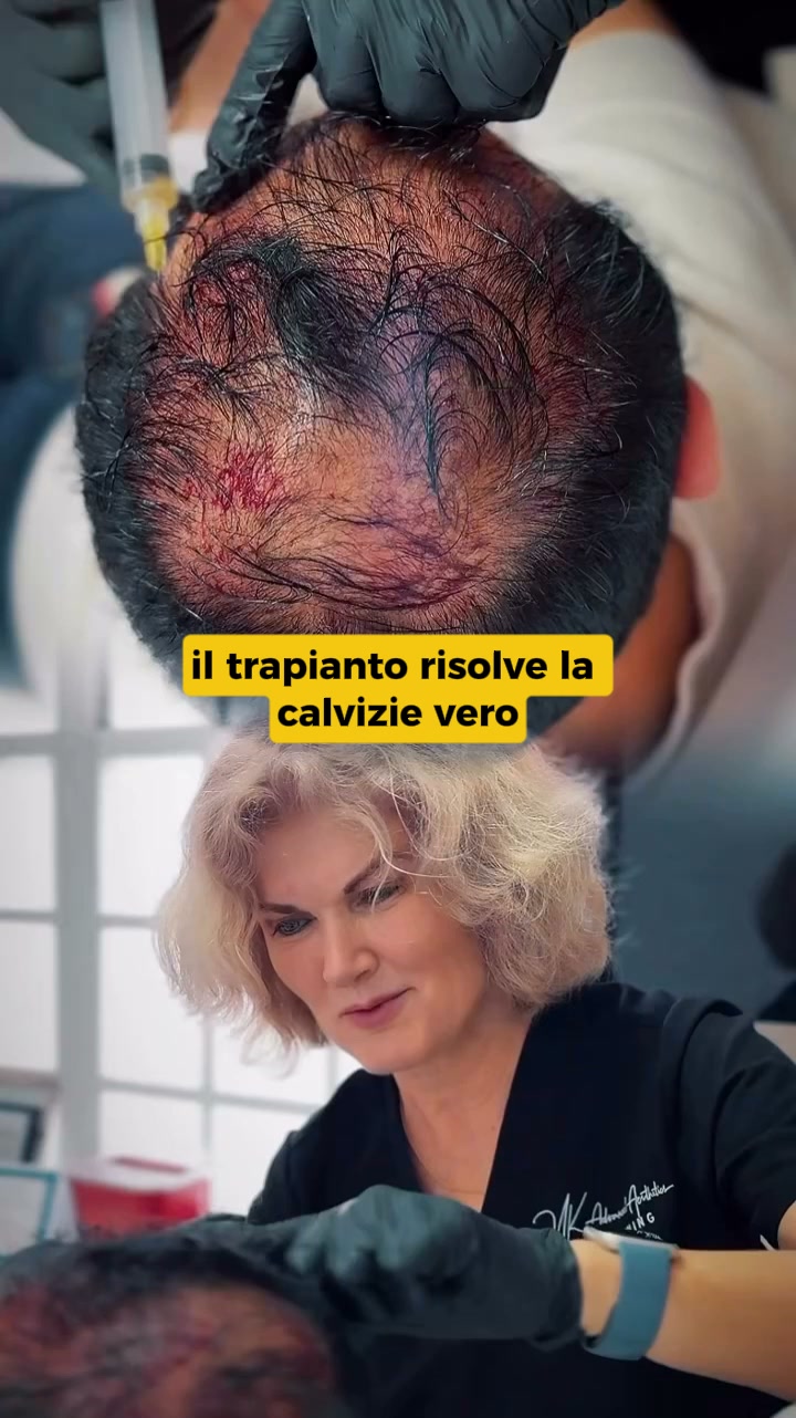 Cosa succede ai capelli che non trapiantano