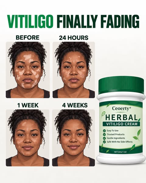 Fast and easy fix for vitiligo.