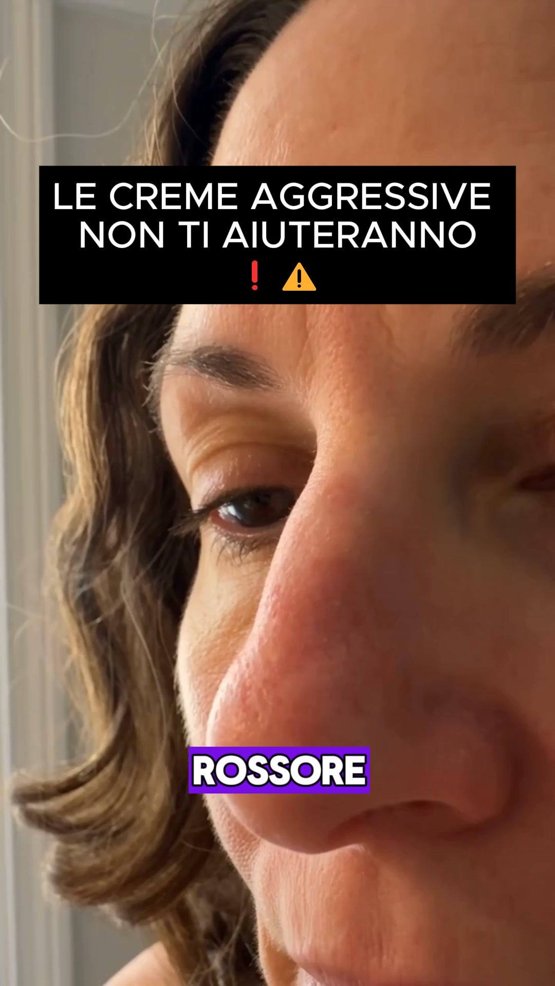 Supporto naturale per la tua Dermatite Seborroica