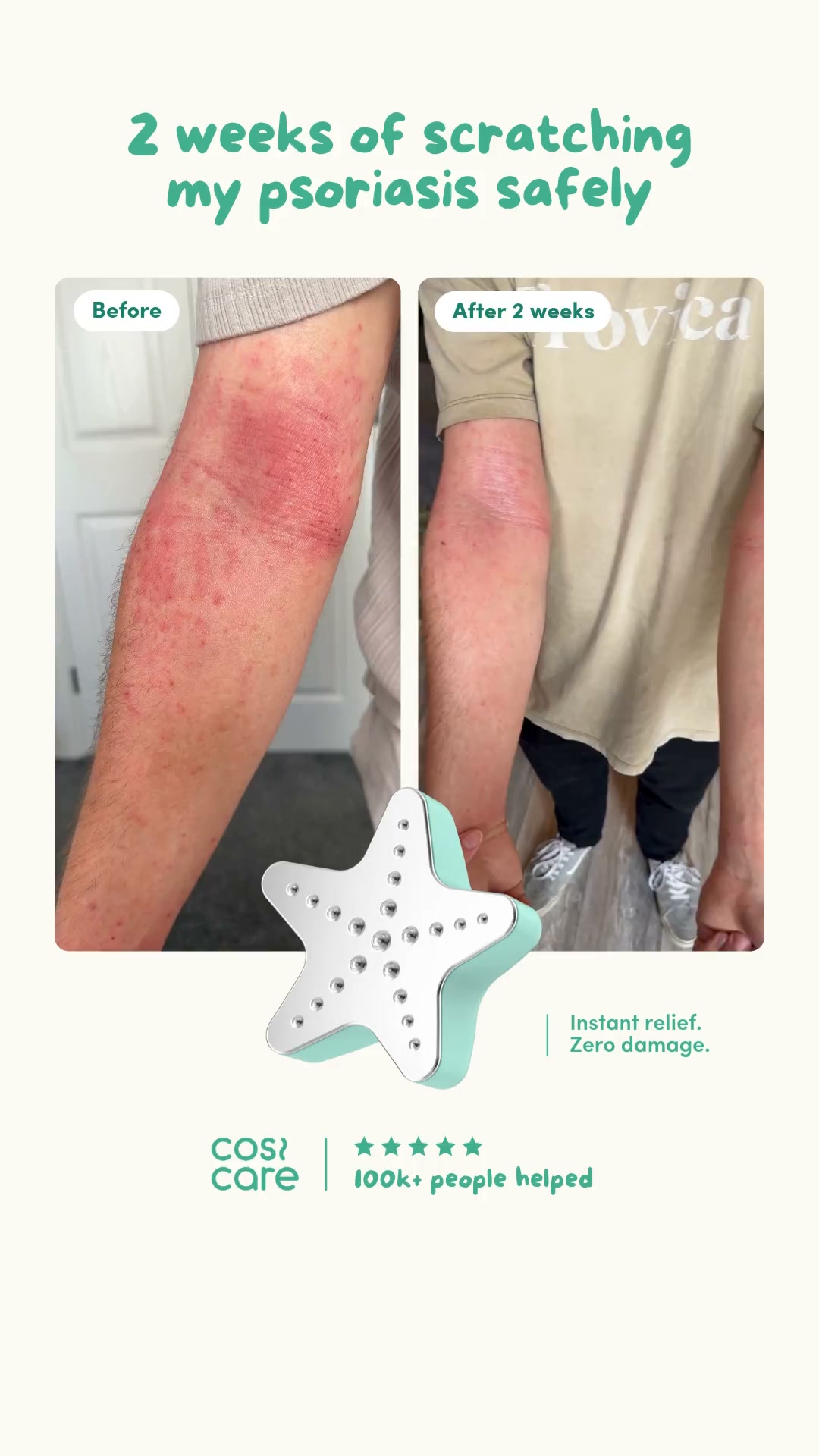 Psoriasis Itch, Cooled