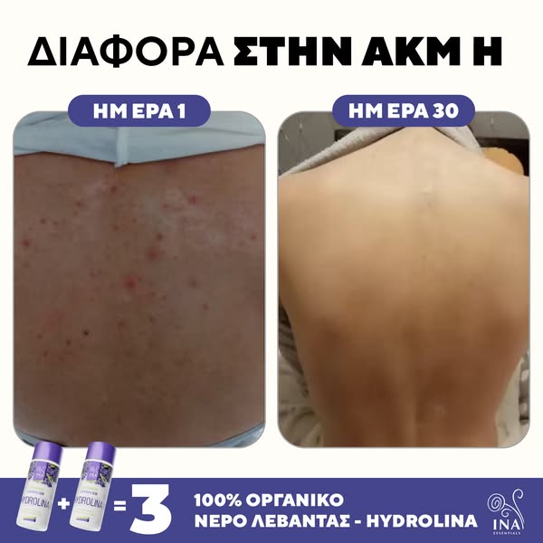 2+1 θεραπεία ακμής με λεβάντα: Πάρτε τη δική σας!