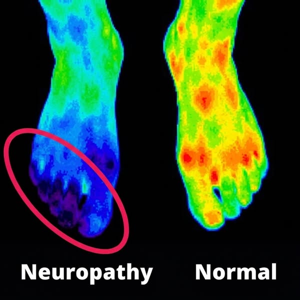 Fix Neuropathy Naturally