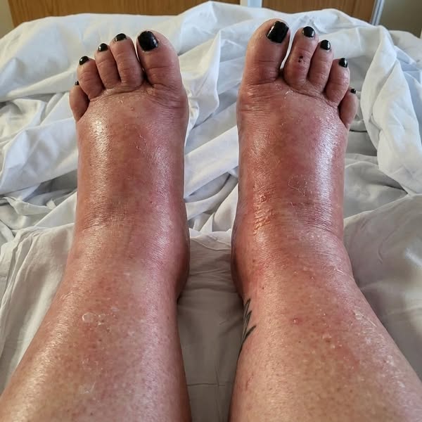 My wife had Oedema and passed away. I miss her.