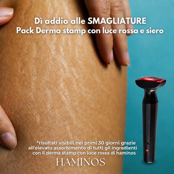 Prenditi cura delle tue smagliature da casa
