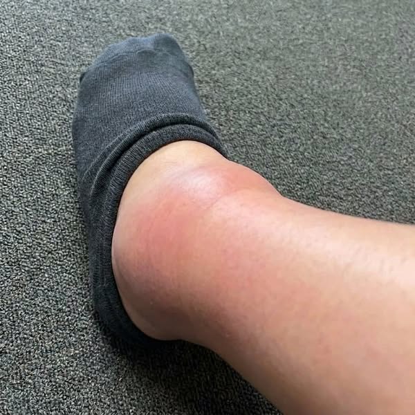 "5 years of my oedema swelling gone in 1 month?"