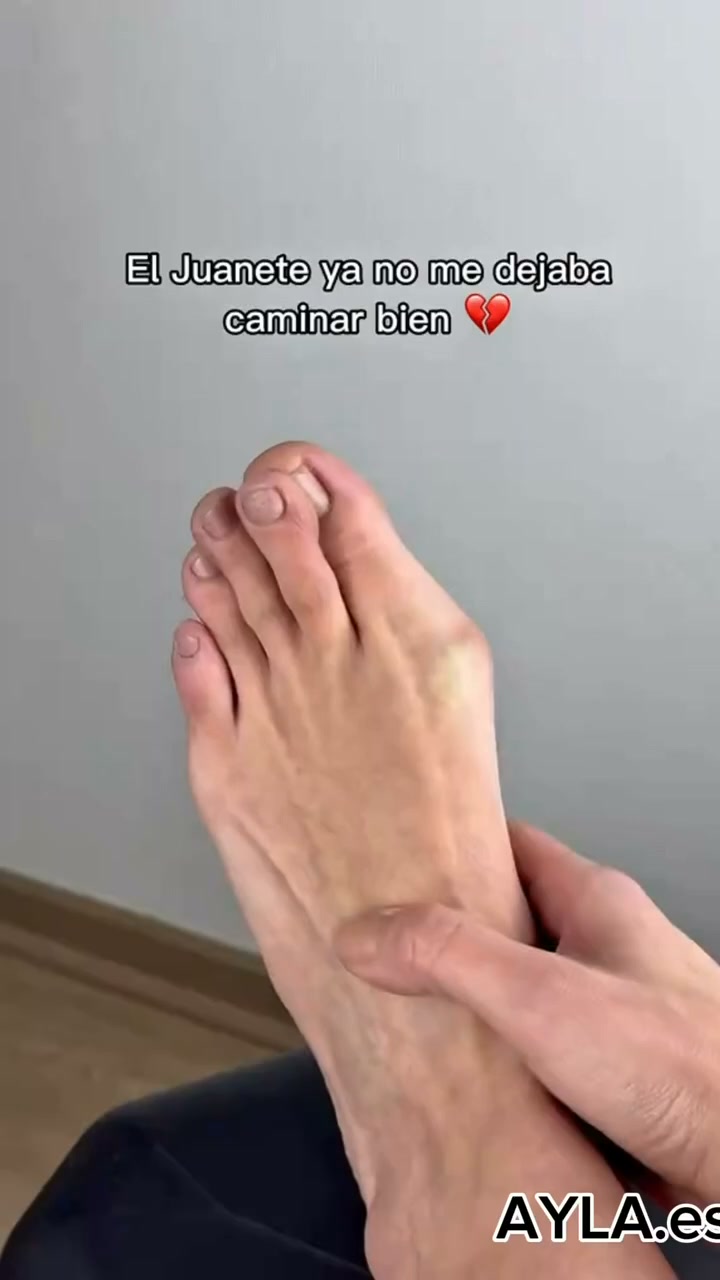 Alivio y comodidad para tus juanetes