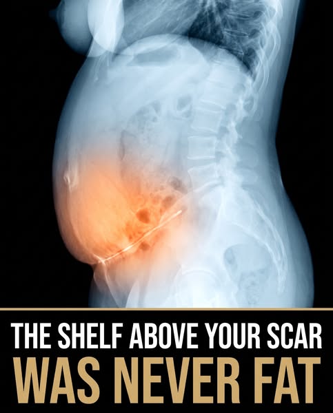 The shelf above your scar was never fat.