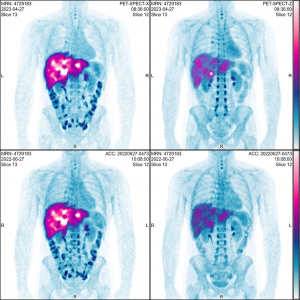 TO MEN WHO'VE BEEN TOLD FATTY LIVER ISN'T A BIG DEAL