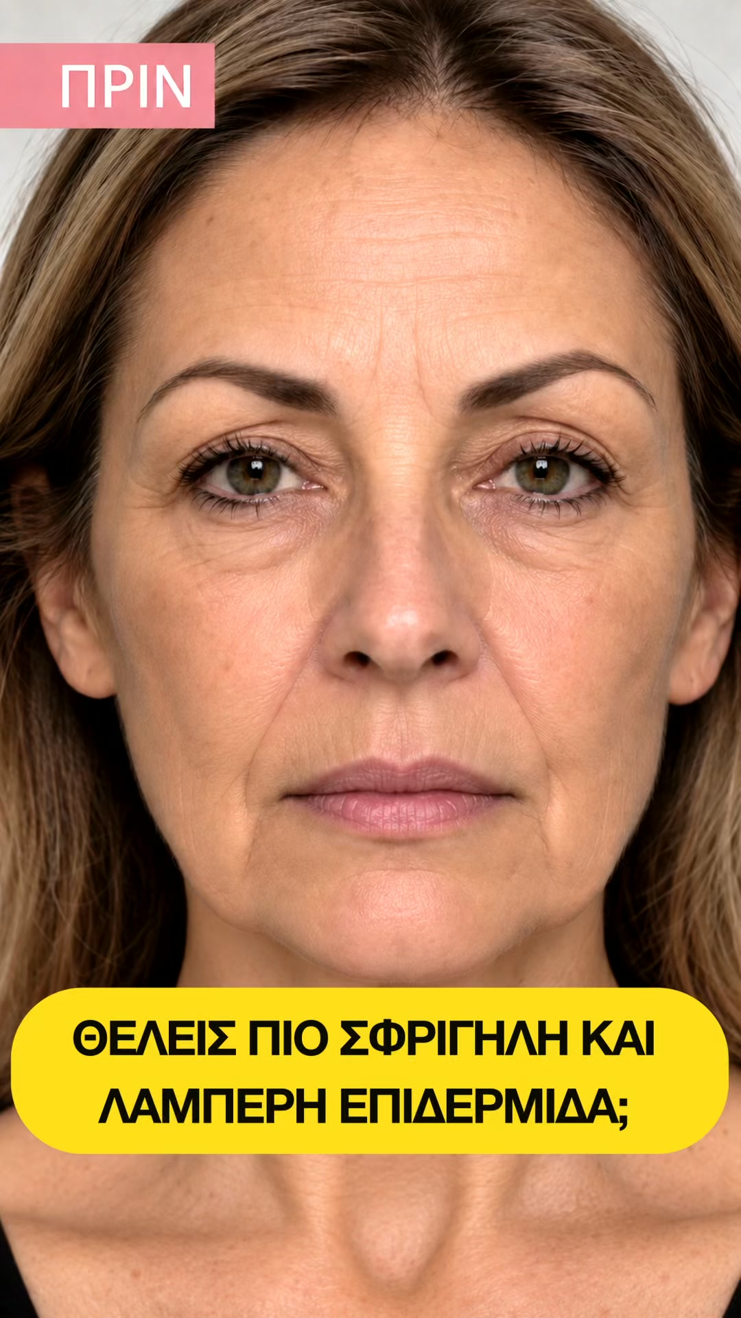 Η σύσφιξη έχει όνομα: Collagen Lift®