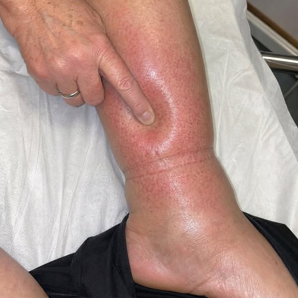 My wife had Oedema and passed away. I miss her.