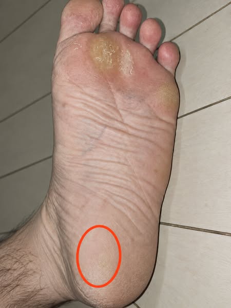 Read this if you are a runner over 45 with plantar fasciitis and cannot get through a comeback without it returning no matter what you try.