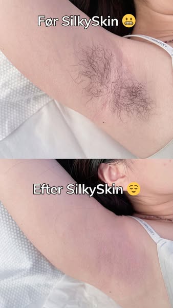 Slip for barberknopper for altid