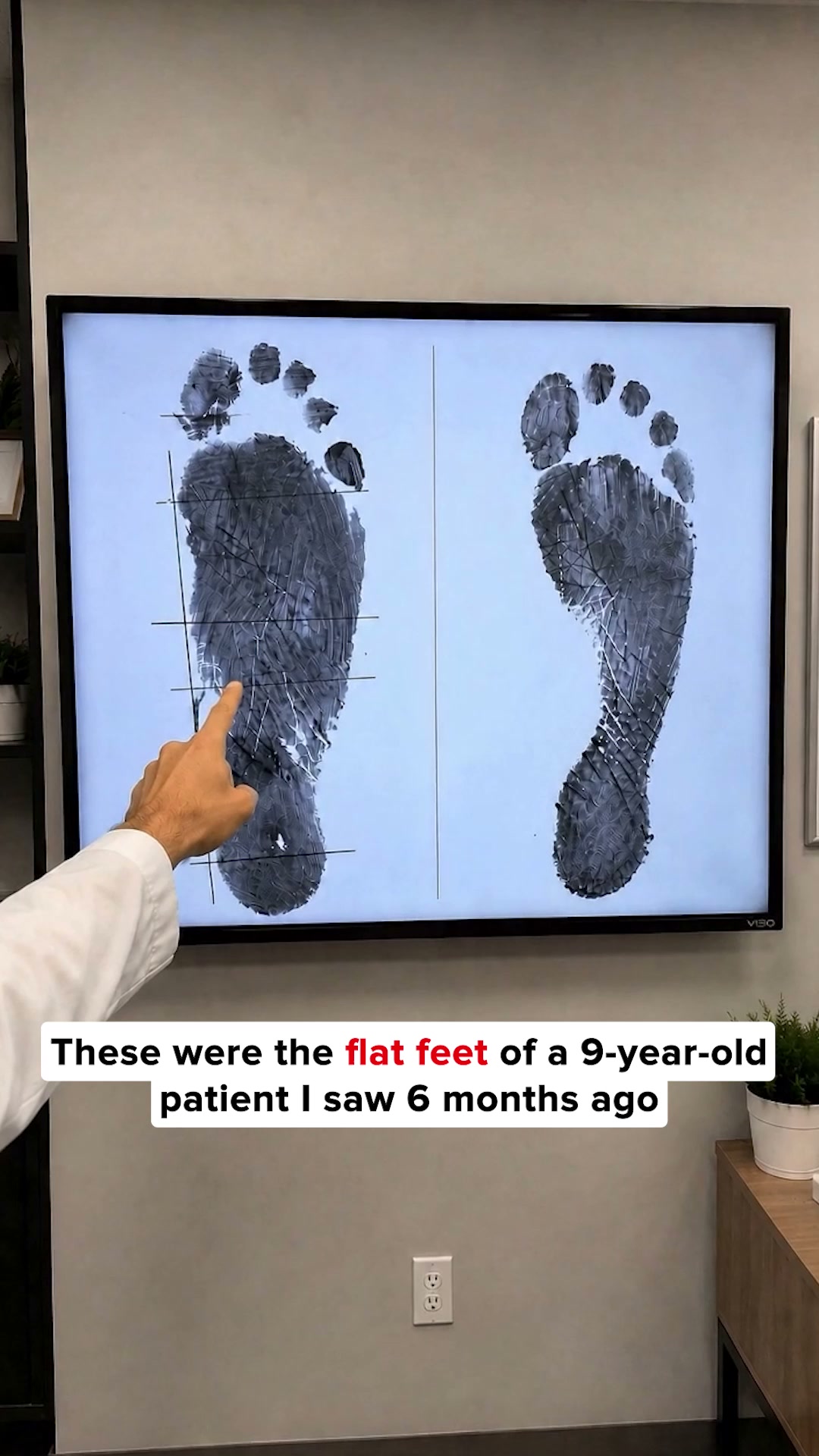 Support Flat Feet the Right Way
