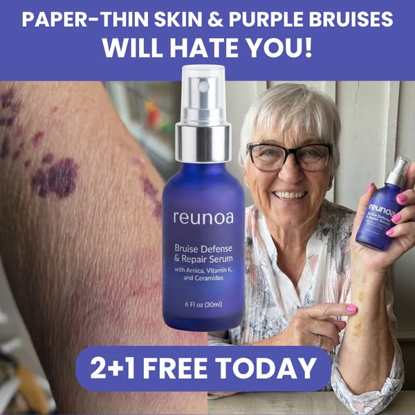 Bruises Gone In Days!
