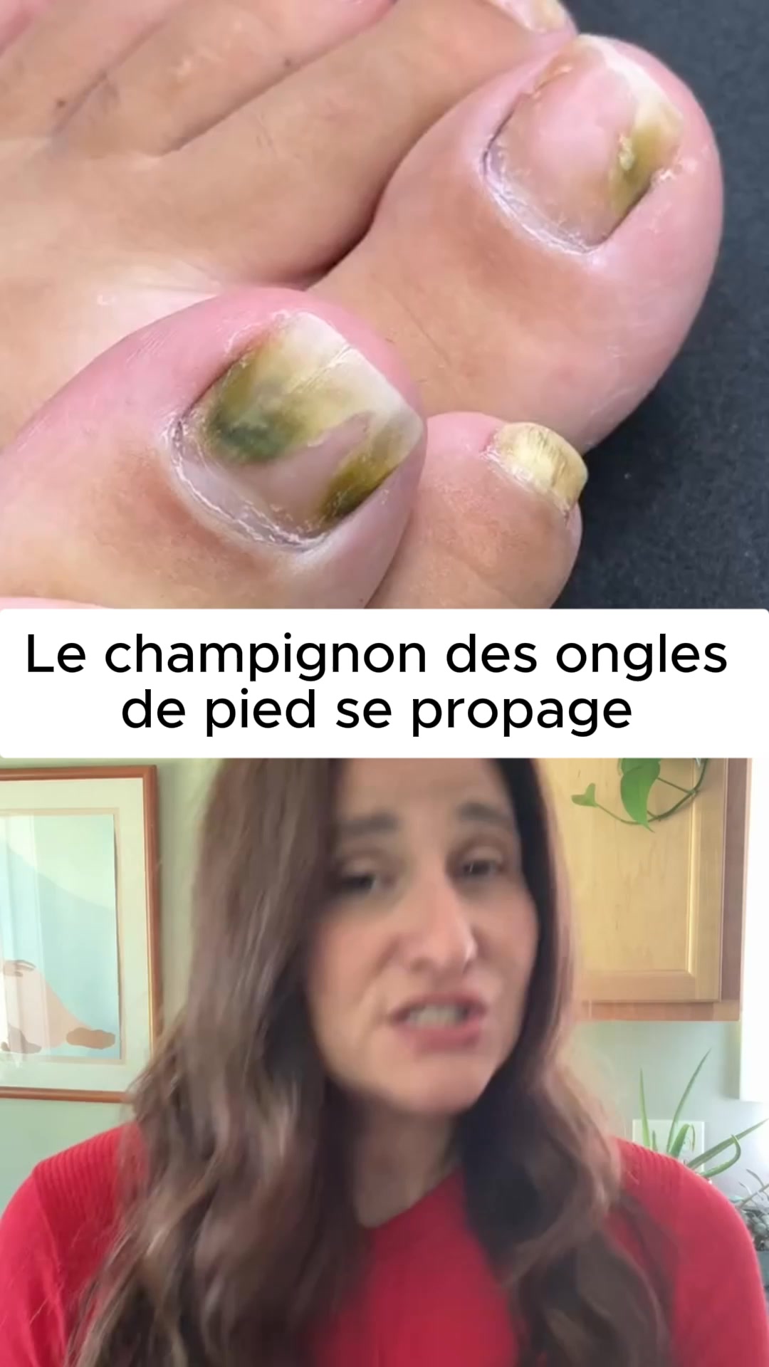 Élimine les mycoses des ongles au contact ‼