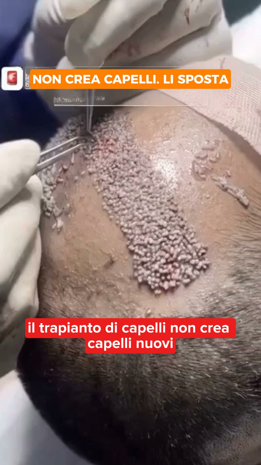 La verità che non ti dicono sul trapianto dei capelli