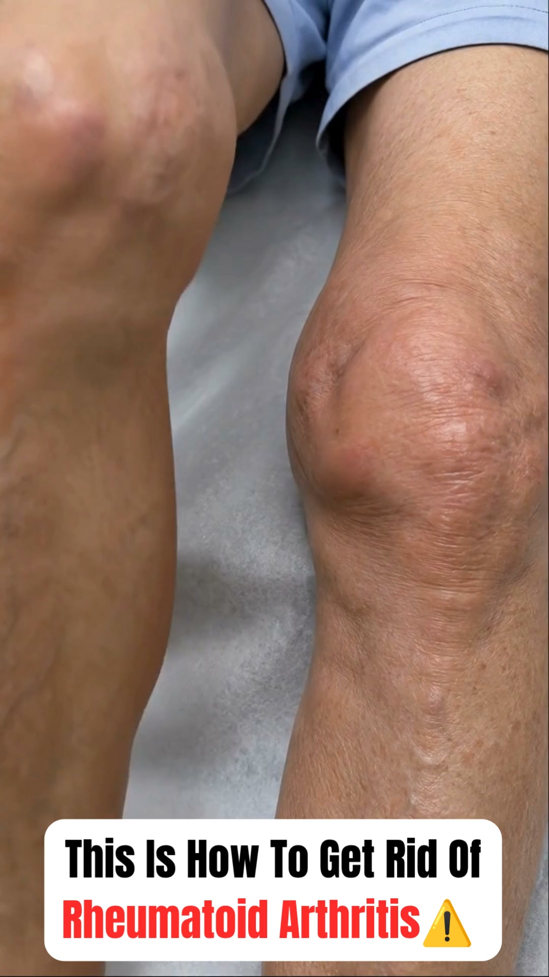 The truth about rheumatoid arthritis