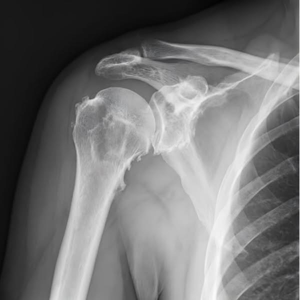 Which Mineral Can Be Best For Relieving Shoulder Pain?