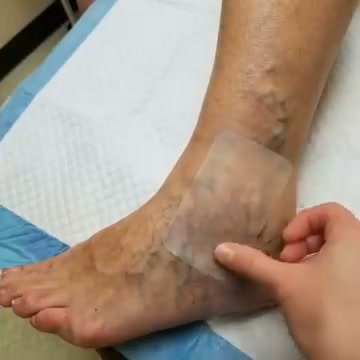 Limited Surprise Discount Ends Tonight – ASVS Approved Vein Patch For Aching, Swollen Legs