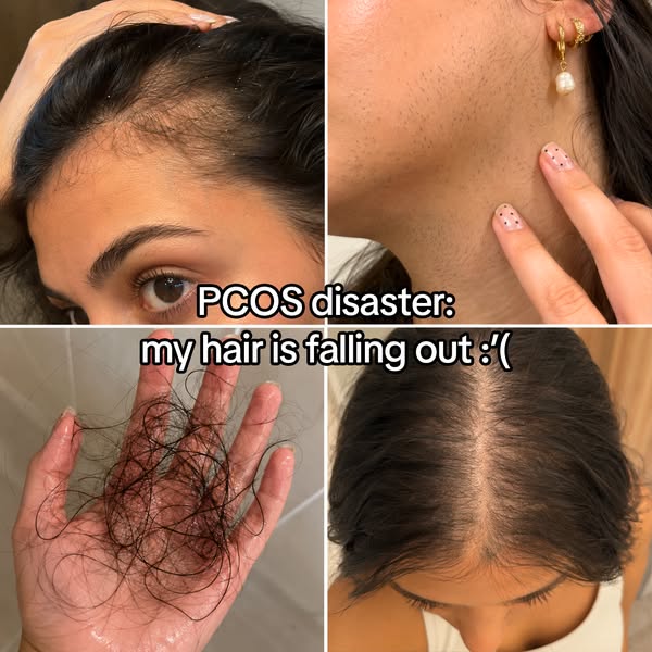 PCOS girlies losing hair every wash? Read this