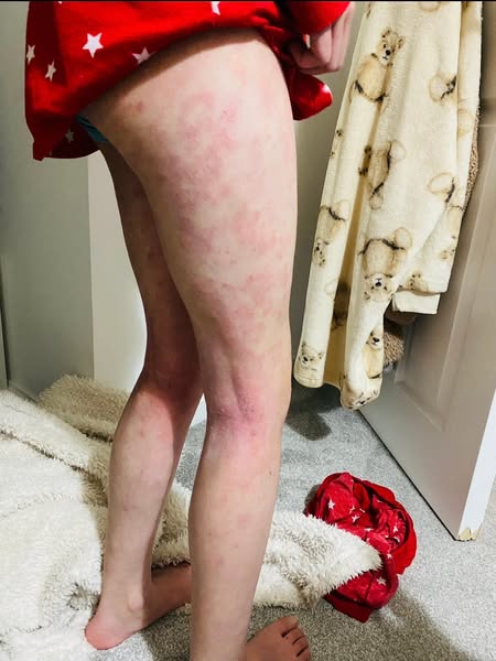 Relief For Sensitive, Eczema-Prone Skin.