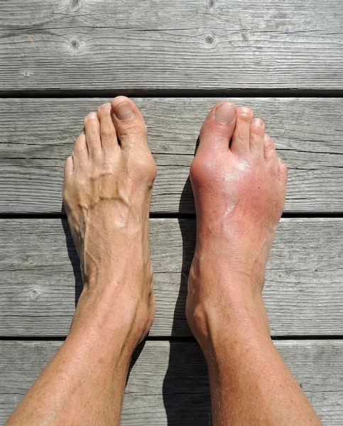 Read this if you deal with gout