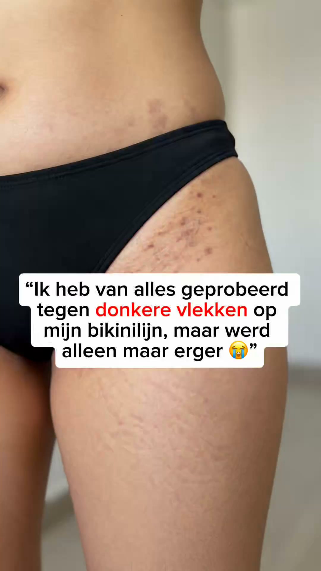 Natuurlijke kracht tegen hardnekkige Pigmentvlekken