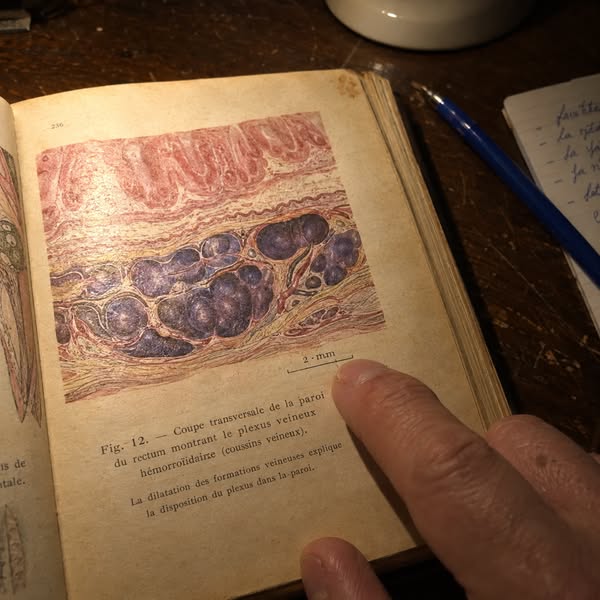 À lire si vos hémorroïdes reviennent