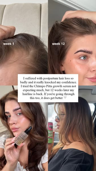 My postpartum hair journey with Chāmpo