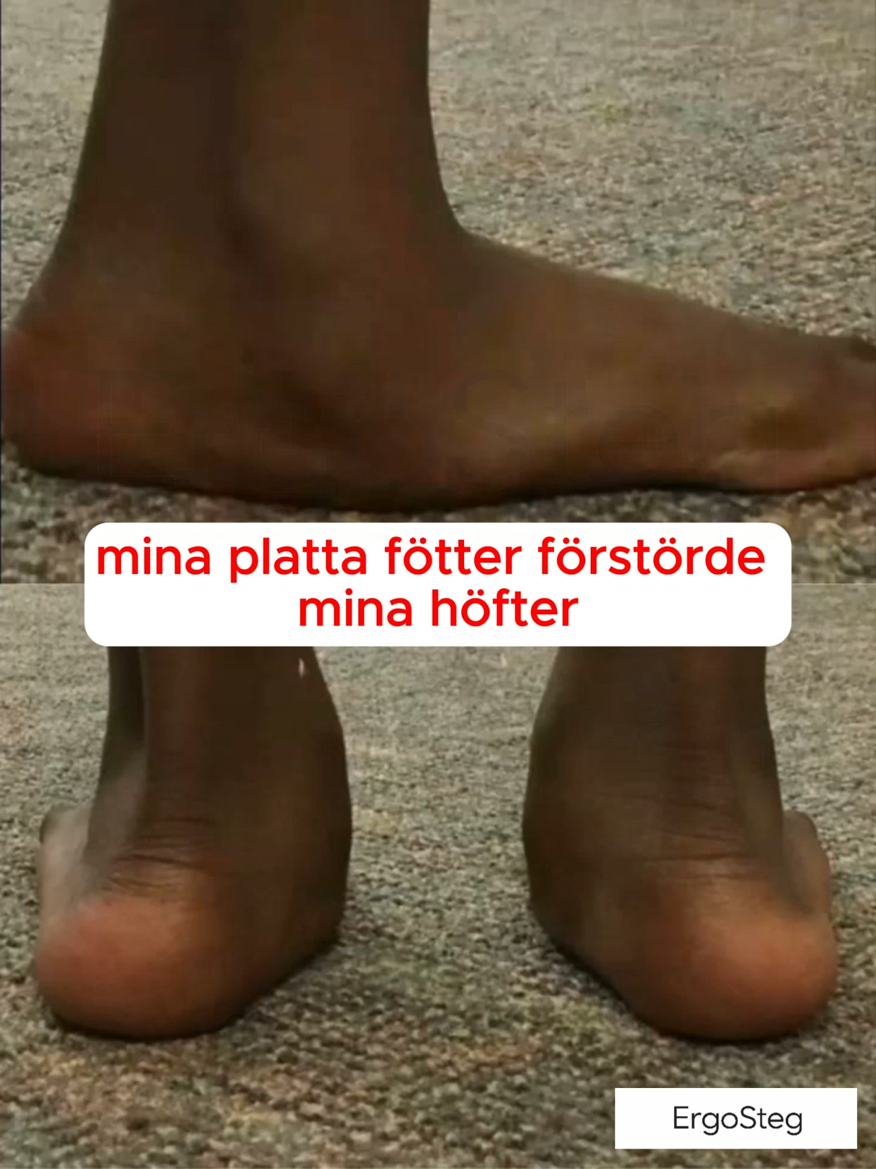 Höftsmärta? Börja med fötterna