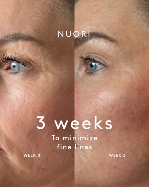 Fine lines, visibly softened.