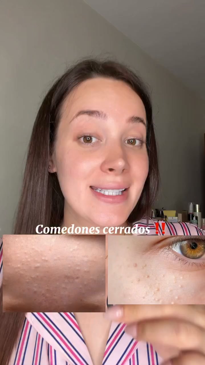 Retinal para comedones cerrados