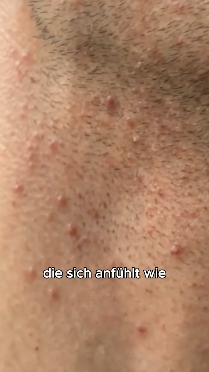 Damenbart? Hör auf zu rasieren, zupfen oder Lasern!