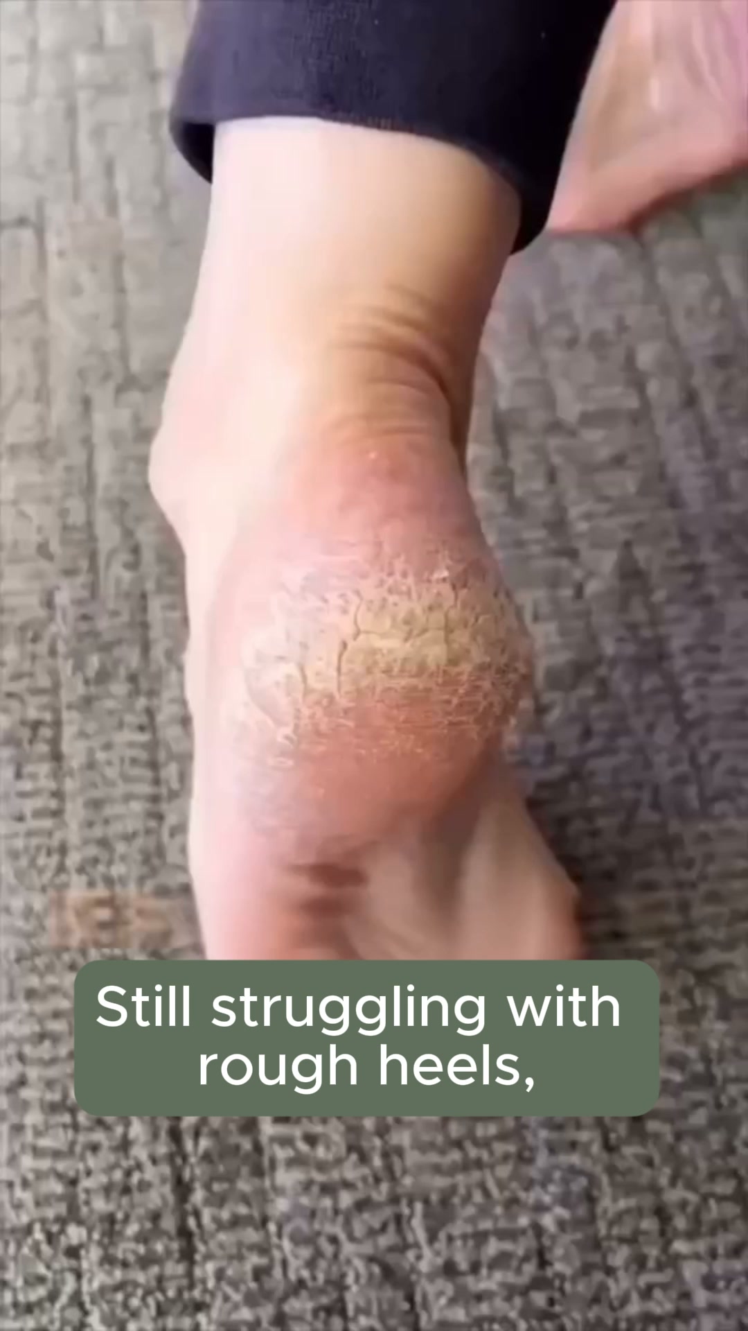 Say Goodbye to Rough Heels