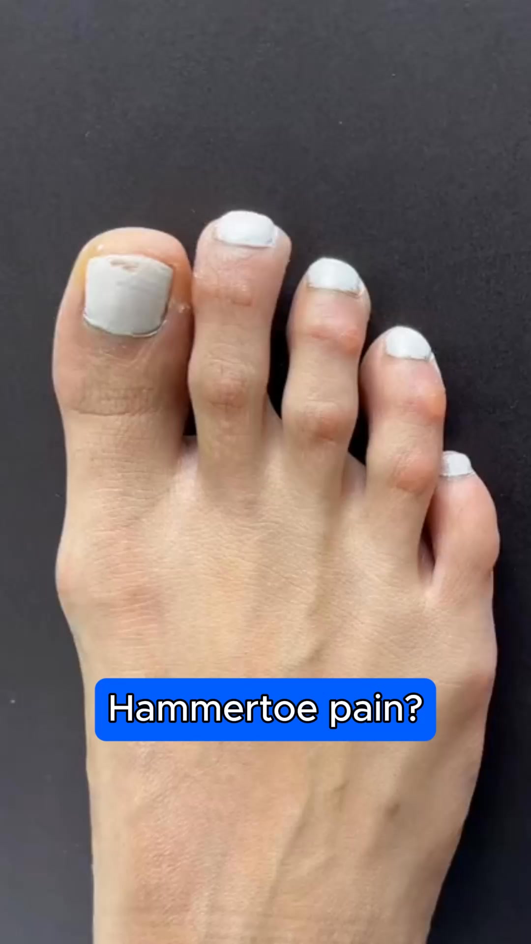 The best way to fix your hammertoes